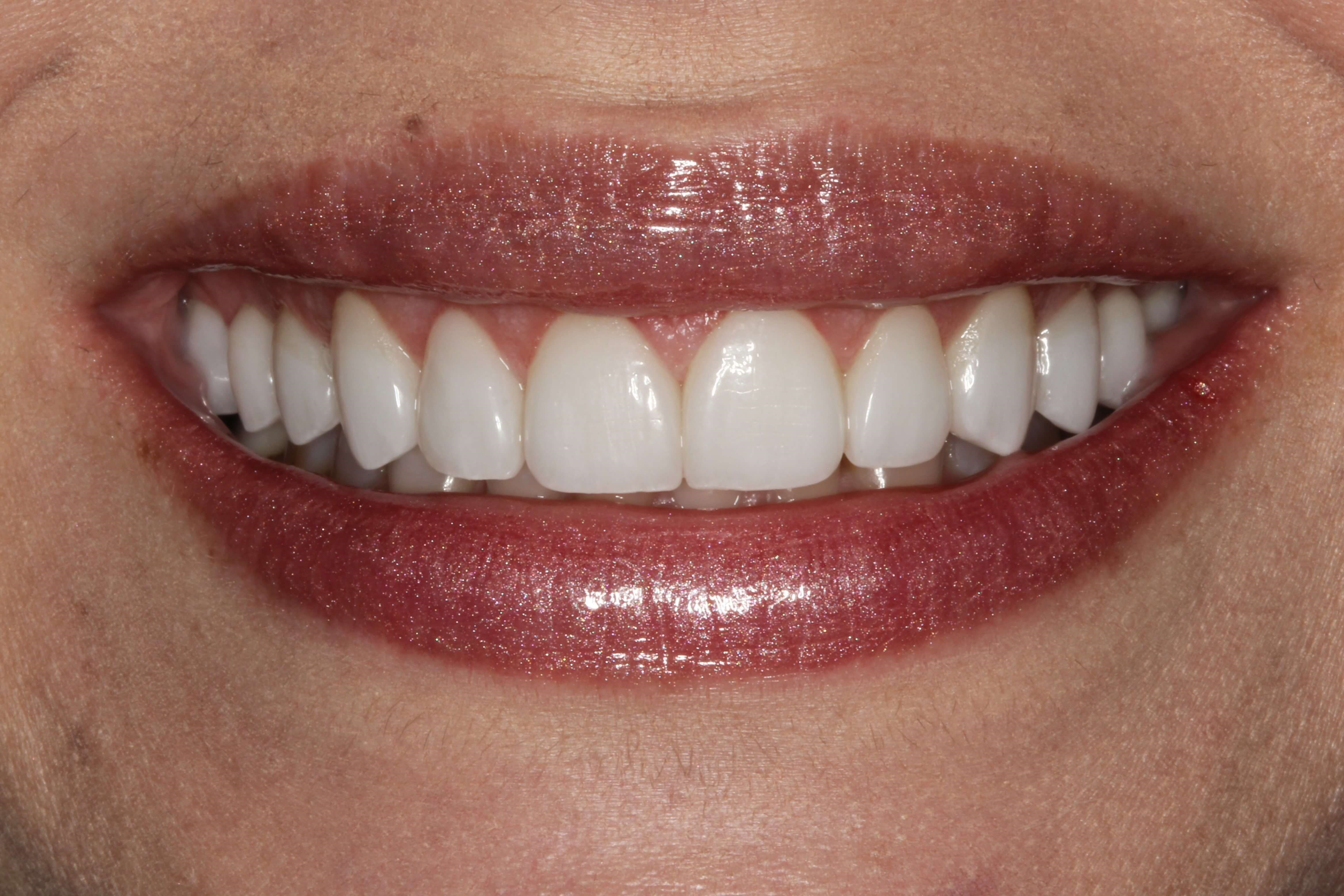 What Is The Difference Between Cosmetic Dentistry Vs. General Dentistry?